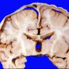 8A1 Hygroma, Subdural Chronic (Case 8) b