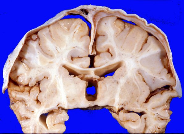 8A1 Hygroma, Subdural Chronic (Case 8) b