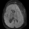 9A1 Hygroma, shunt HC, & Cranio 3 yr prior (Case 9) Flair 3 - Copy