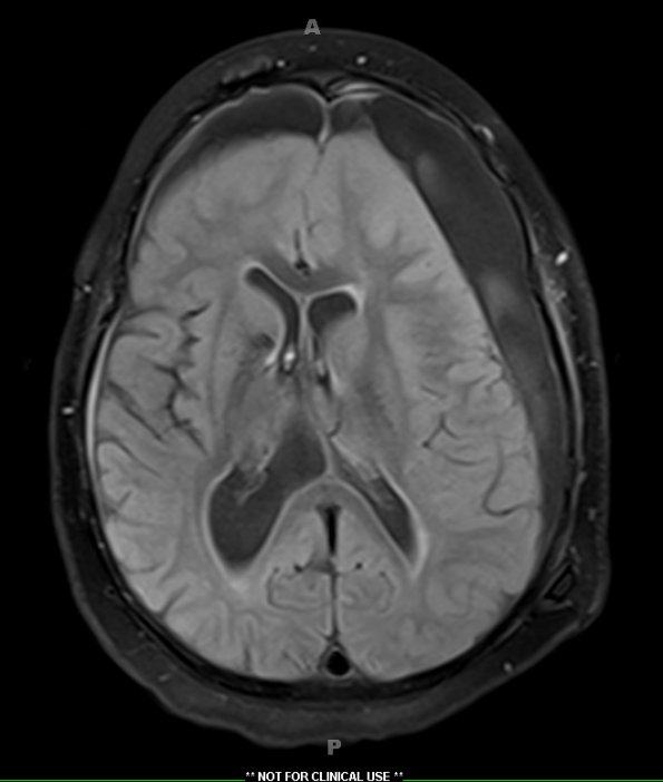 9A1 Hygroma, shunt HC, & Cranio 3 yr prior (Case 9) Flair 3 - Copy