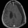 9A2 Hygroma, shunt HC, & Cranio 3 yr prior (Case 9) T1W 2 - Copy