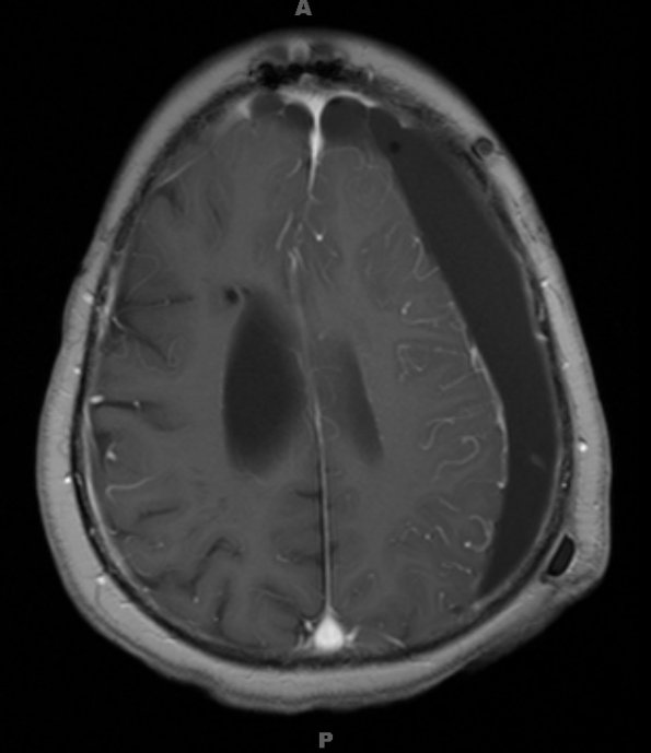 9A2 Hygroma, shunt HC, & Cranio 3 yr prior (Case 9) T1W 2 - Copy