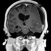 9A3 Hygroma, shunt HC, & Cranio 3 yr prior (Case 9) T1W 4 - Copy