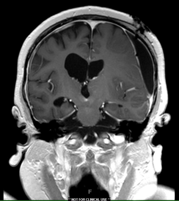 9A3 Hygroma, shunt HC, & Cranio 3 yr prior (Case 9) T1W 4 - Copy