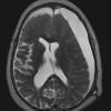 9A4 Hygroma, shunt HC, & Cranio 3 yr prior (Case 9) T2 1 - Copy