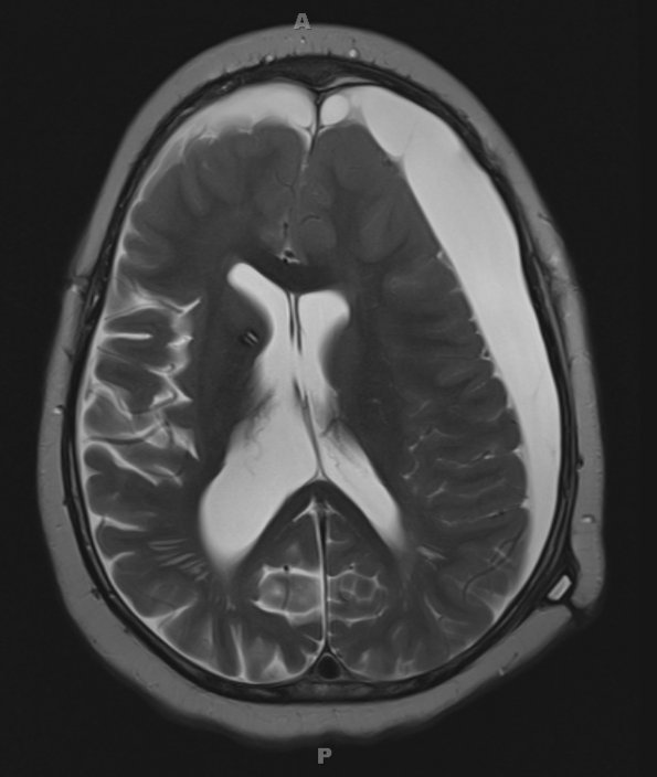 9A4 Hygroma, shunt HC, & Cranio 3 yr prior (Case 9) T2 1 - Copy