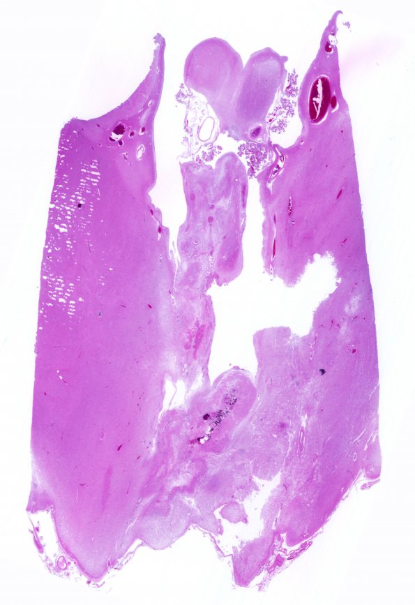 9C1 Craniopharyngioma, status post surgery & radiation (Case 9)  N11 H&E whole mount