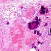 9C3 Craniopharyngioma, status post surgery & radiation (Case 9) N11 H&E 1