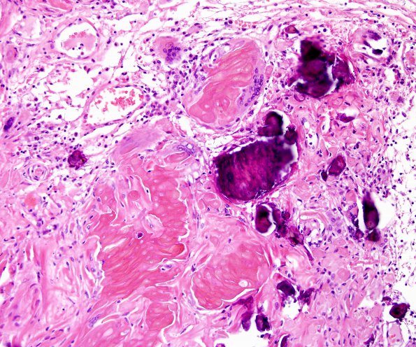 9C3 Craniopharyngioma, status post surgery & radiation (Case 9) N11 H&E 1