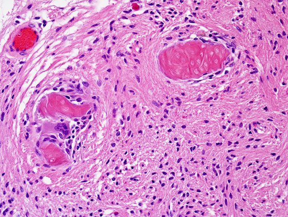 9C4 Craniopharyngioma, status post surgery & radiation (Case 9) N12 H&E 2