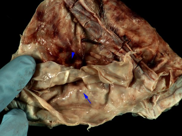 9D1 Hygroma, shunt HC, & Cranio 3 yr prior (Case 9) 2 copy