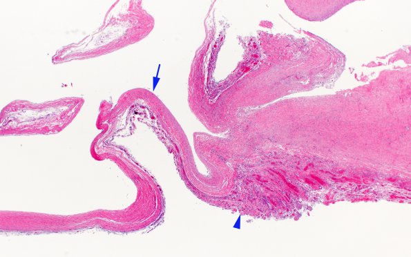 9E1 (Case 9) N13 H&E 2X copy