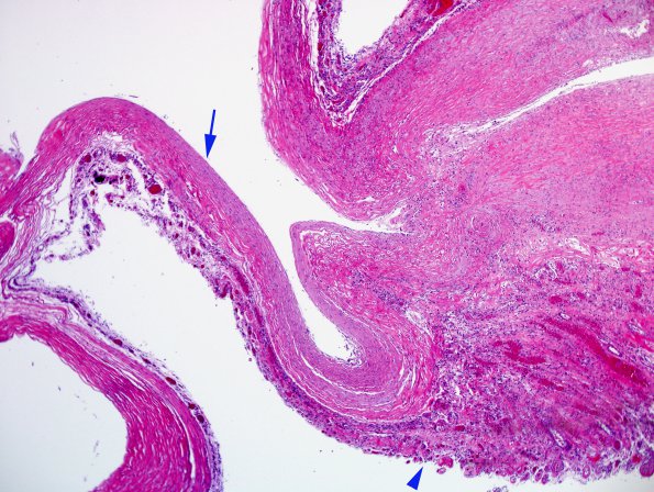 9E2 Hygroma, subdural left (Case 9) N13 H&E 1 copy