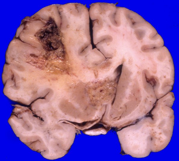 1A1 GBM, Uncal & cingulate hernition (Case 1) 1