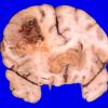 1A2 GBM, Uncal & cingulate hernition (Case 1) 4