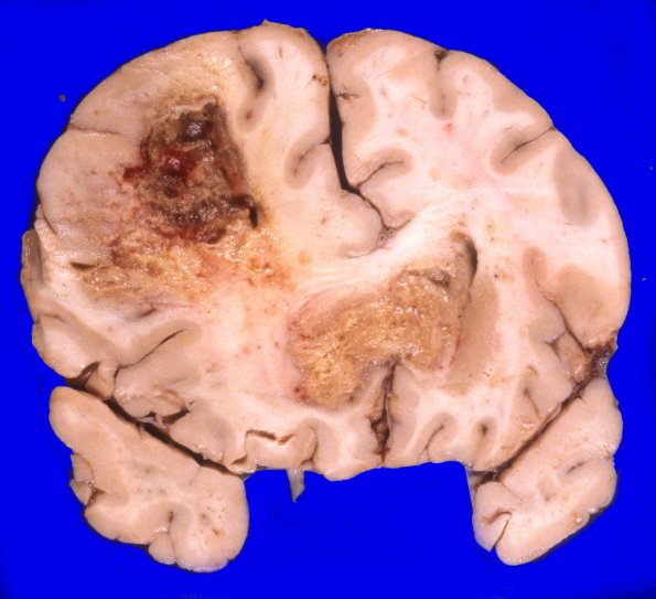 1A2 GBM, Uncal & cingulate hernition (Case 1) 4