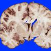 2A1 Infarct, hemorrhagic (Case 2) 8 copy