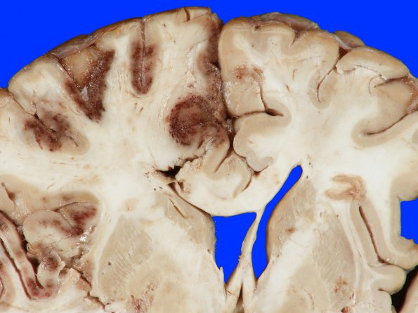 2A2 Herniation, cingulate, Infarct, hemorrhagic (Case 2) gross_5A