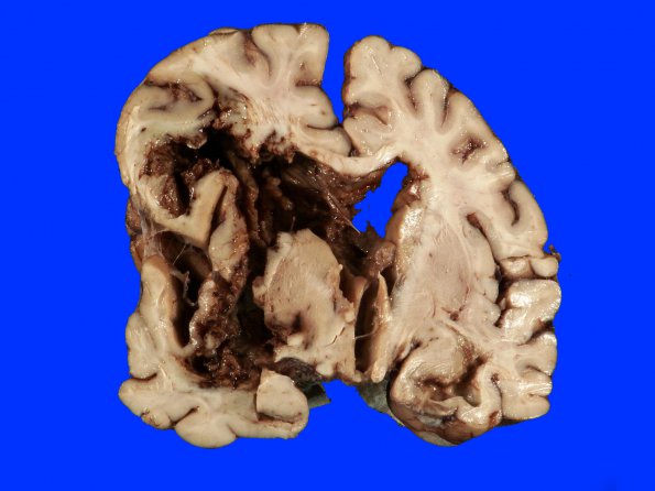 3A1 Hemorrhage, HT, uncal & cingulate herniation (Case 3) Gross_5