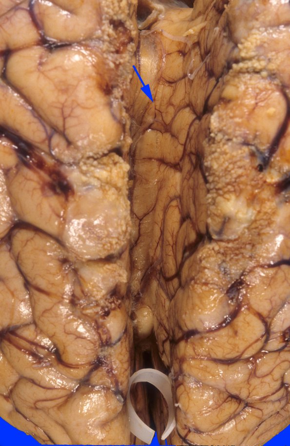 4A1 Herniation, cingulate (Case 4) 1 copy