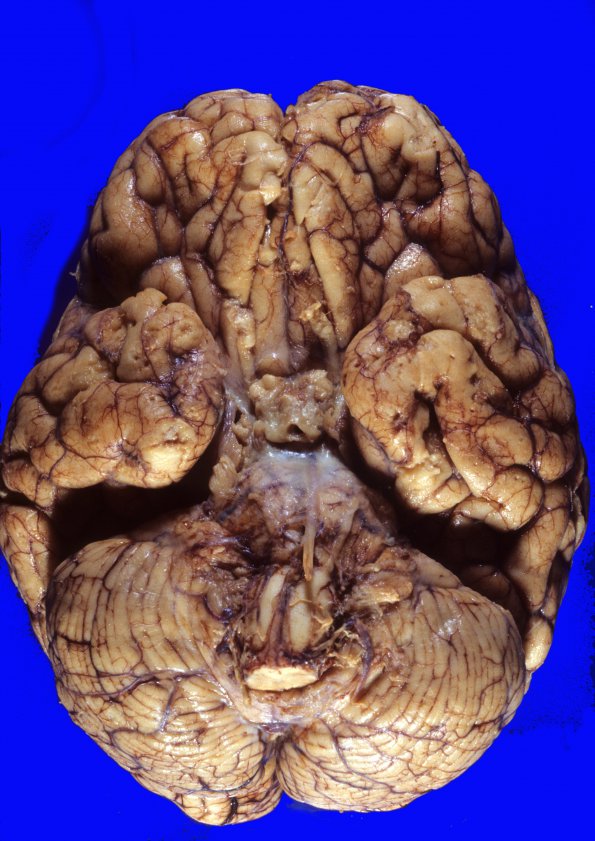 10A1 TB Tuberculoma (Case 10) 2