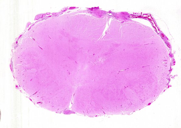 10B1 TB Tuberculoma (Case 10) 3H