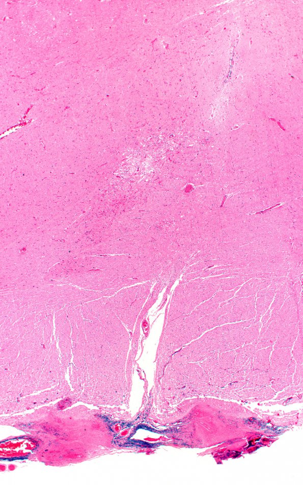 10B2 TB Tuberculoma (Case 10) 2X