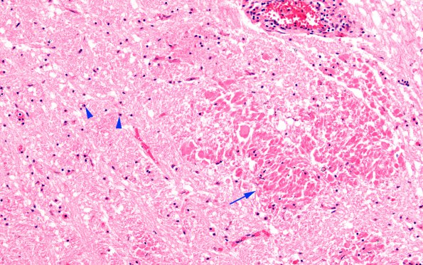 10B6 TB Tuberculoma (Case 10) 3G copy