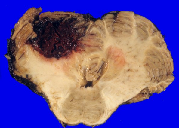 11A1 Hemorrhage, anti-coagulation Rx & tonsillar herniation (Case 11) 3