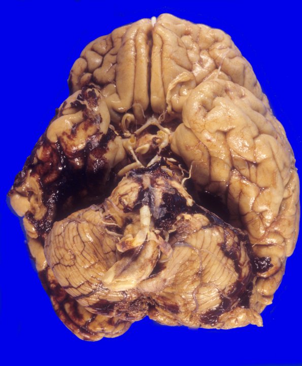 11A2 Hemorrhage, anti-coagulation Rx & tonsillar herniation (Case 11) 2