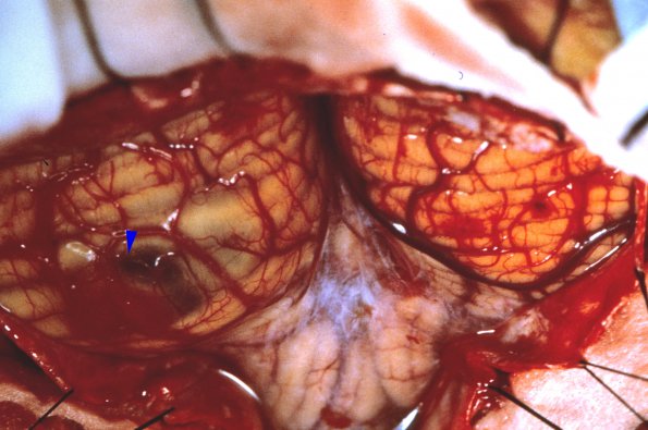 12A Herniation tonsillar 1 (Case 12A)