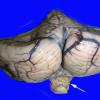 12C1 herniation, tonsils (Case 12C1)