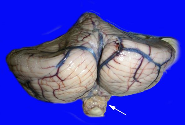 12C1 herniation, tonsils (Case 12C1)