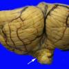 12C2 herniation, tonsils (Case 12C2) copy