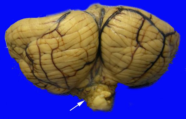 12C2 herniation, tonsils (Case 12C2) copy