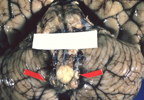 12D Herniation tonsillar (Case 12D) 1