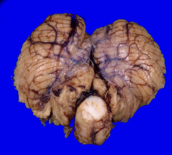 12E A1 Edema, Hypoxia-Ischemia, tonsil (Case 12E)