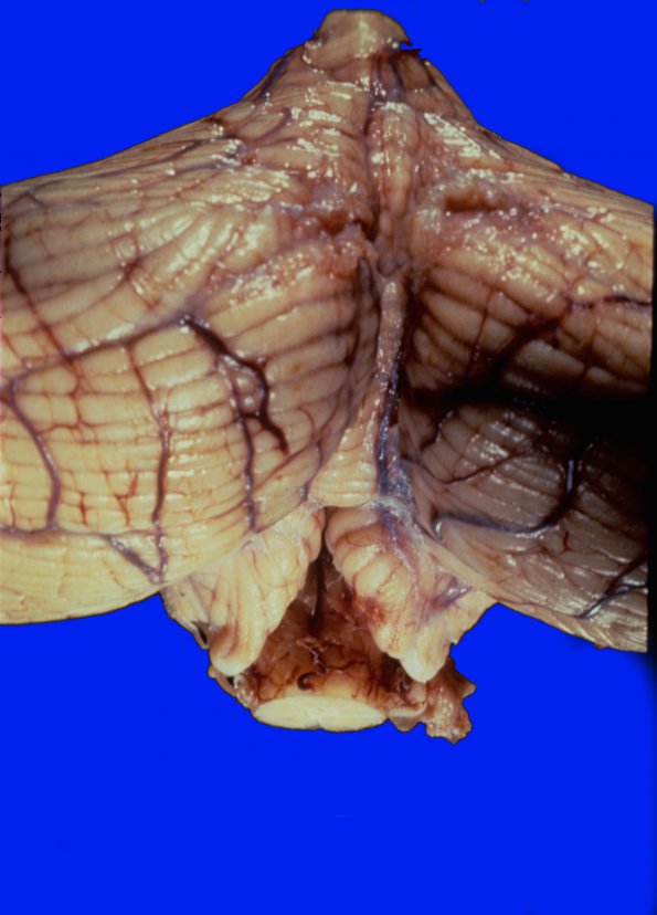 12F Herniation, tonsillar (Case 12F)