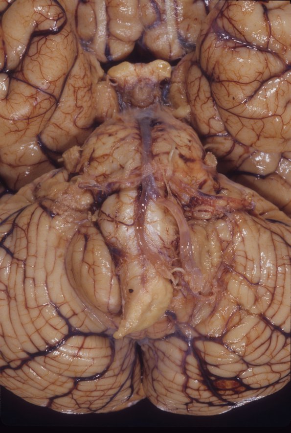 13E Tonsillar Herniation vs normal (Case 13E)