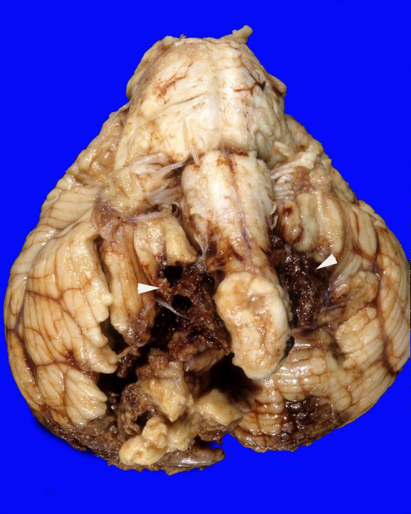 1A2 Infarct, hemorrhagic, Tonsillar Herniation (Case 1) 8 copy