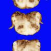 1A4 Infarct, hemorrhagic, Tonsillar Herniation (Case 1) 20