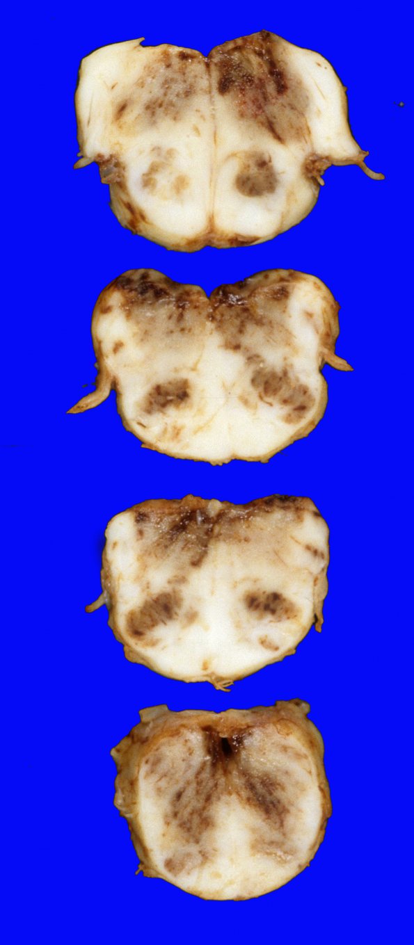 1A4 Infarct, hemorrhagic, Tonsillar Herniation (Case 1) 20