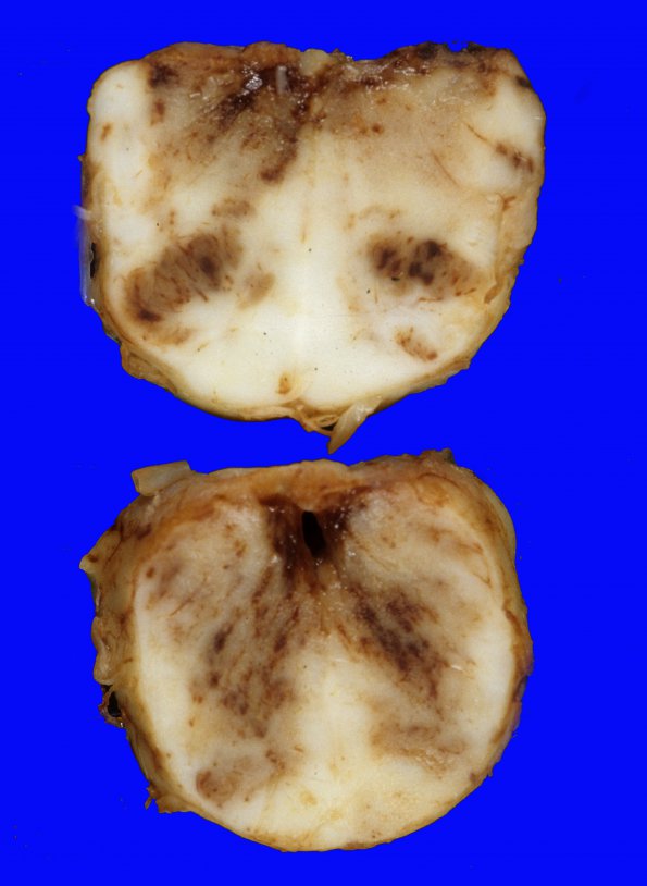 1A5 Infarct, hemorrhagic, Tonsillar Herniation (Case 1) 5