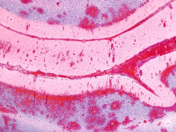 1B2 Hemorrhage, Infarct, HT, tonsillar (Case 1) N26 H&E 2