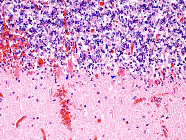 1B3 Hemorrhage, Infarct, HT, tonsillar (Case 1) N26 H&E 1 copy