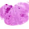 1C1 Infarct, hemorrhagic, Tonsillar Herniation (Case 1) N8 H&E