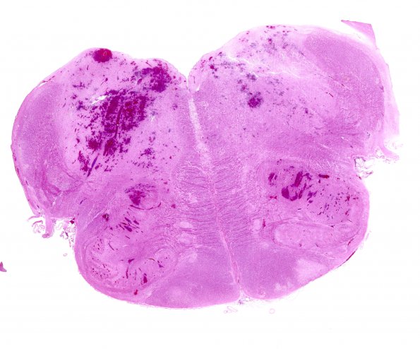 1C1 Infarct, hemorrhagic, Tonsillar Herniation (Case 1) N8 H&E