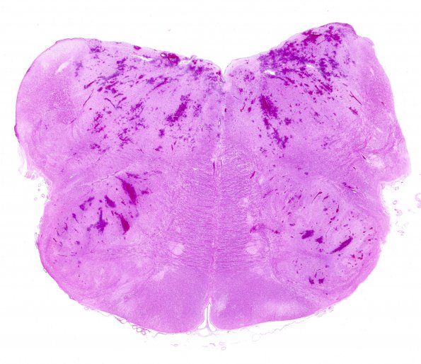 1C2 Infarct, hemorrhagic, Tonsillar Herniation (Case 1) N22 H&E