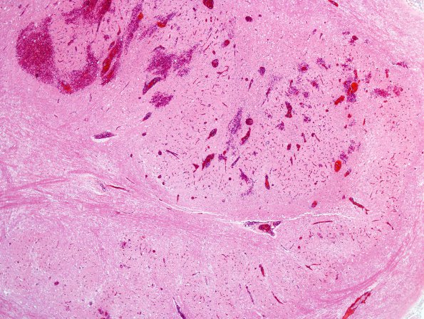 1C3 Infarct, hemorrhagic, Tonsillar Herniation (Case 1) N8 H&E 1