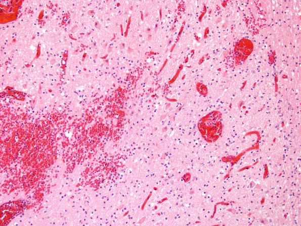 1C4 Infarct, hemorrhagic, Tonsillar Herniation (Case 1) N8 H&E 2